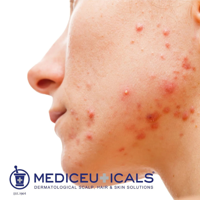 MEDICEUTICALS SOLV-X Shampoo ingredients graphic