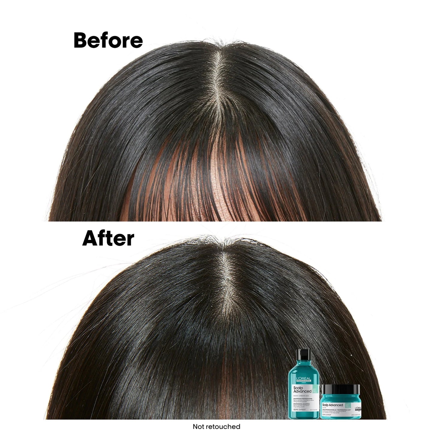 LOREAL Scalp Advanced Shampoo for Anti-oiliness 300ml