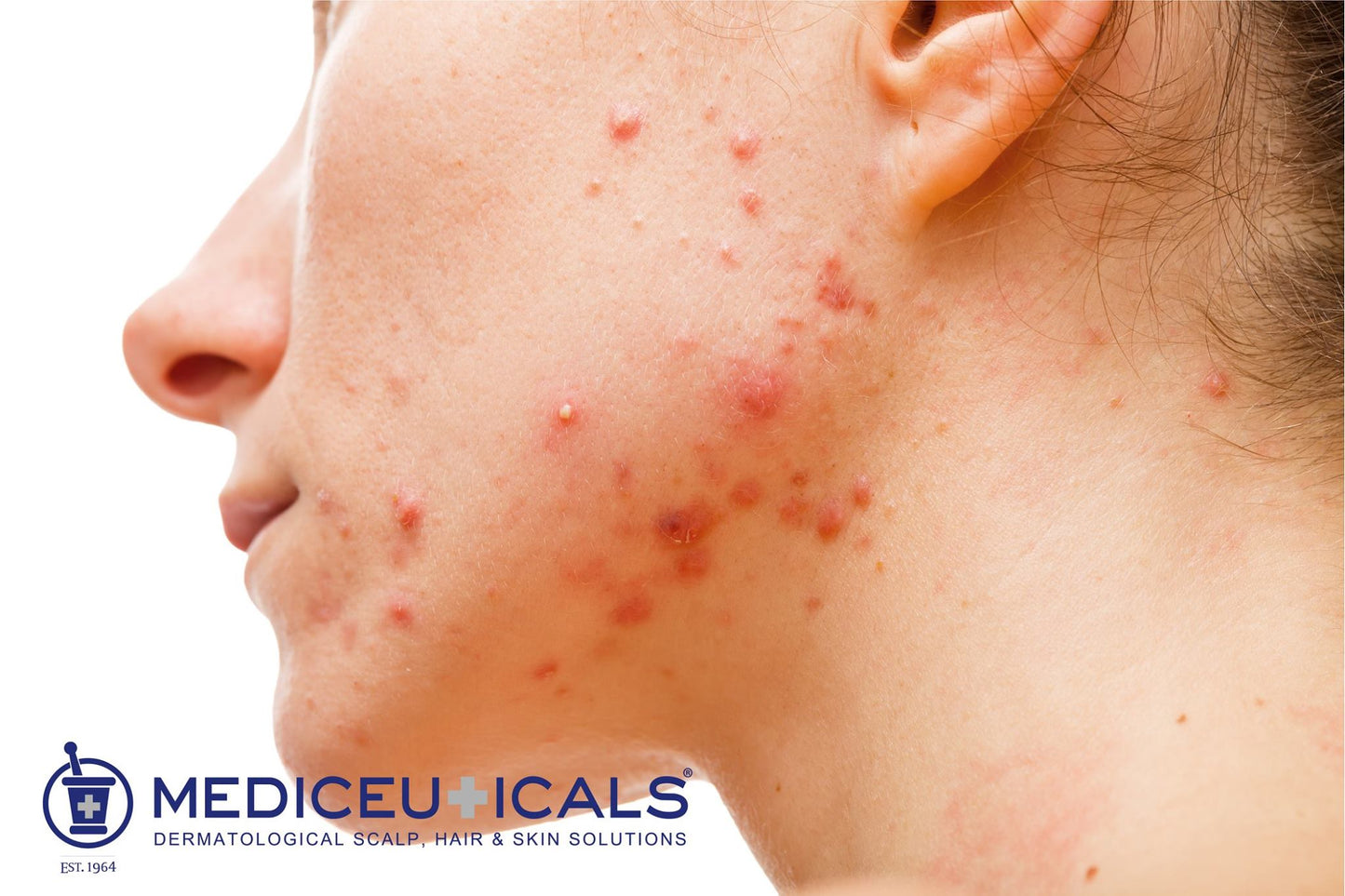 MEDICEUTICALS Scalp Treatment Kit Solv-X For Oily Scalp