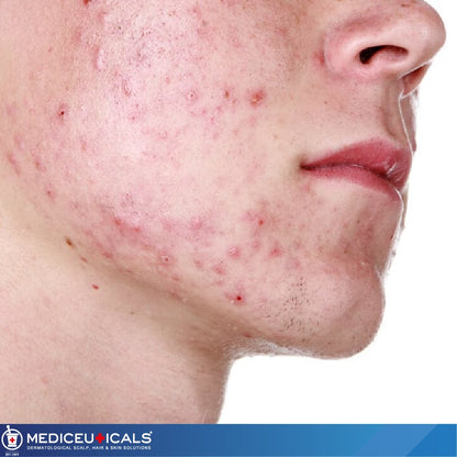 MEDICEUTICALS THERARX™ Purifying Treatment Scalp & Skin Tonic